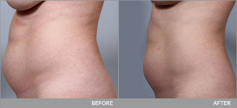 ผลการรักษา กำจัดไขมัน ด้วย BodyFX