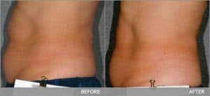 ผลการรักษาด้วยเครื่อง liposonix