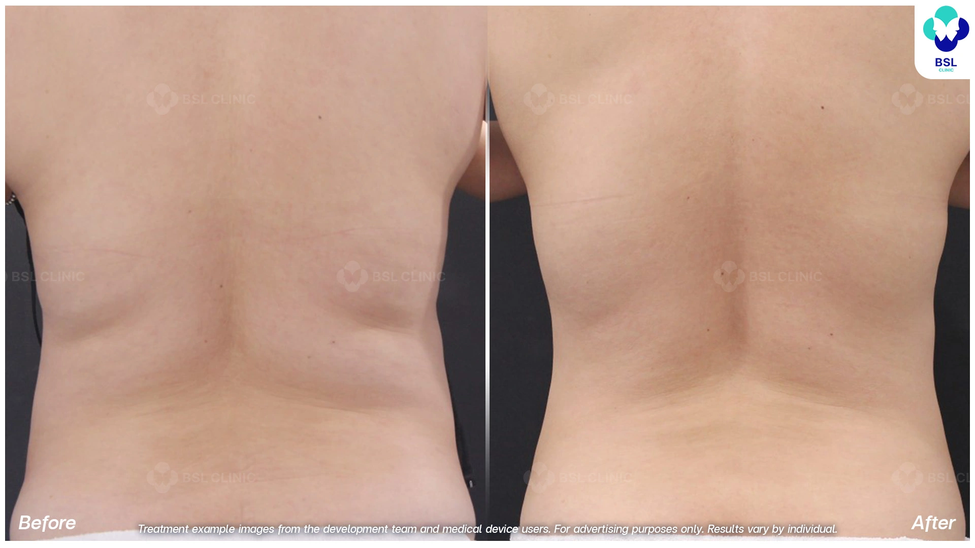 ผลลัพธ์จากการทำ CoolShaping2 Program