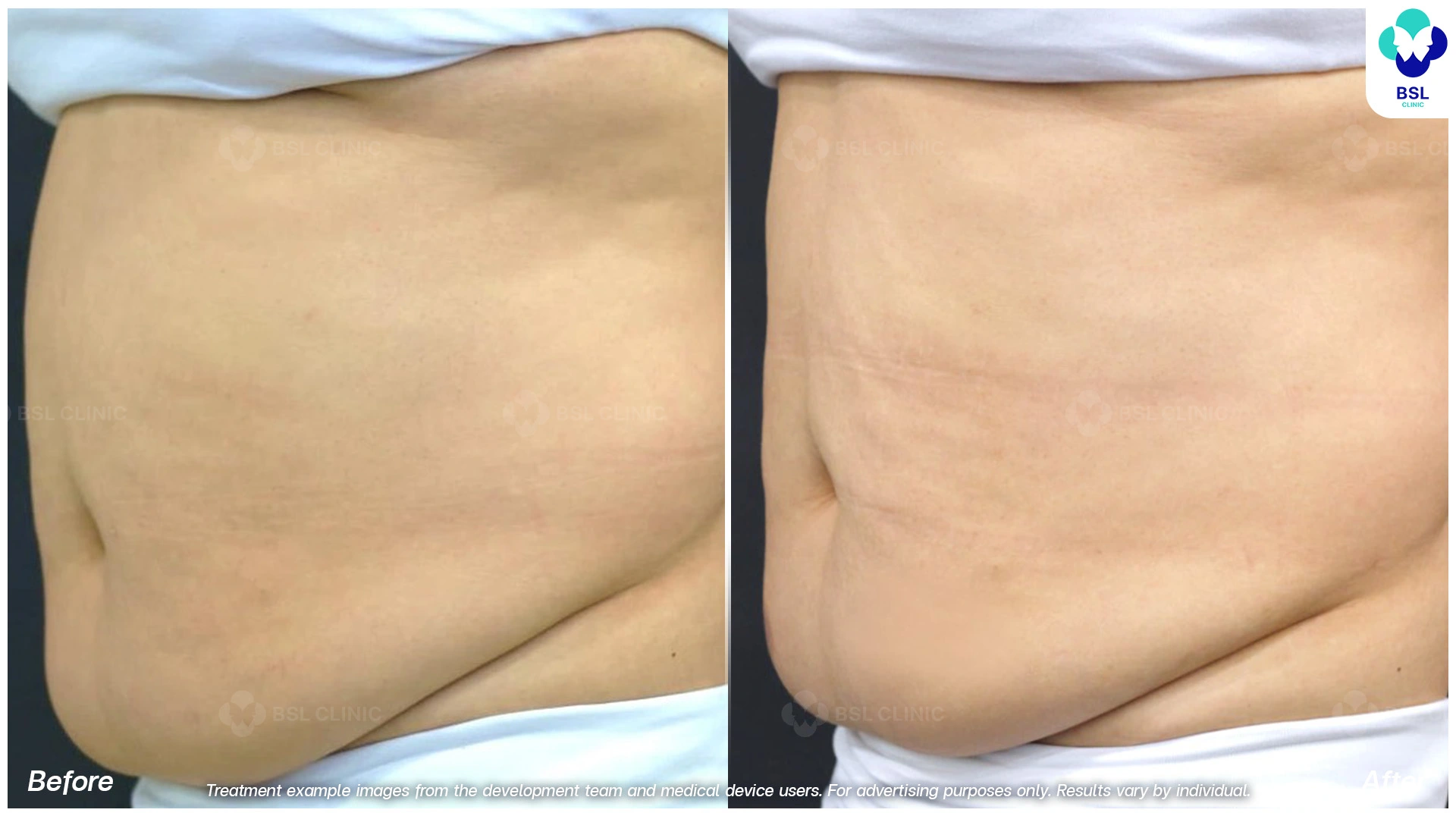 ผลลัพธ์จากการทำ CoolShaping2 Program
