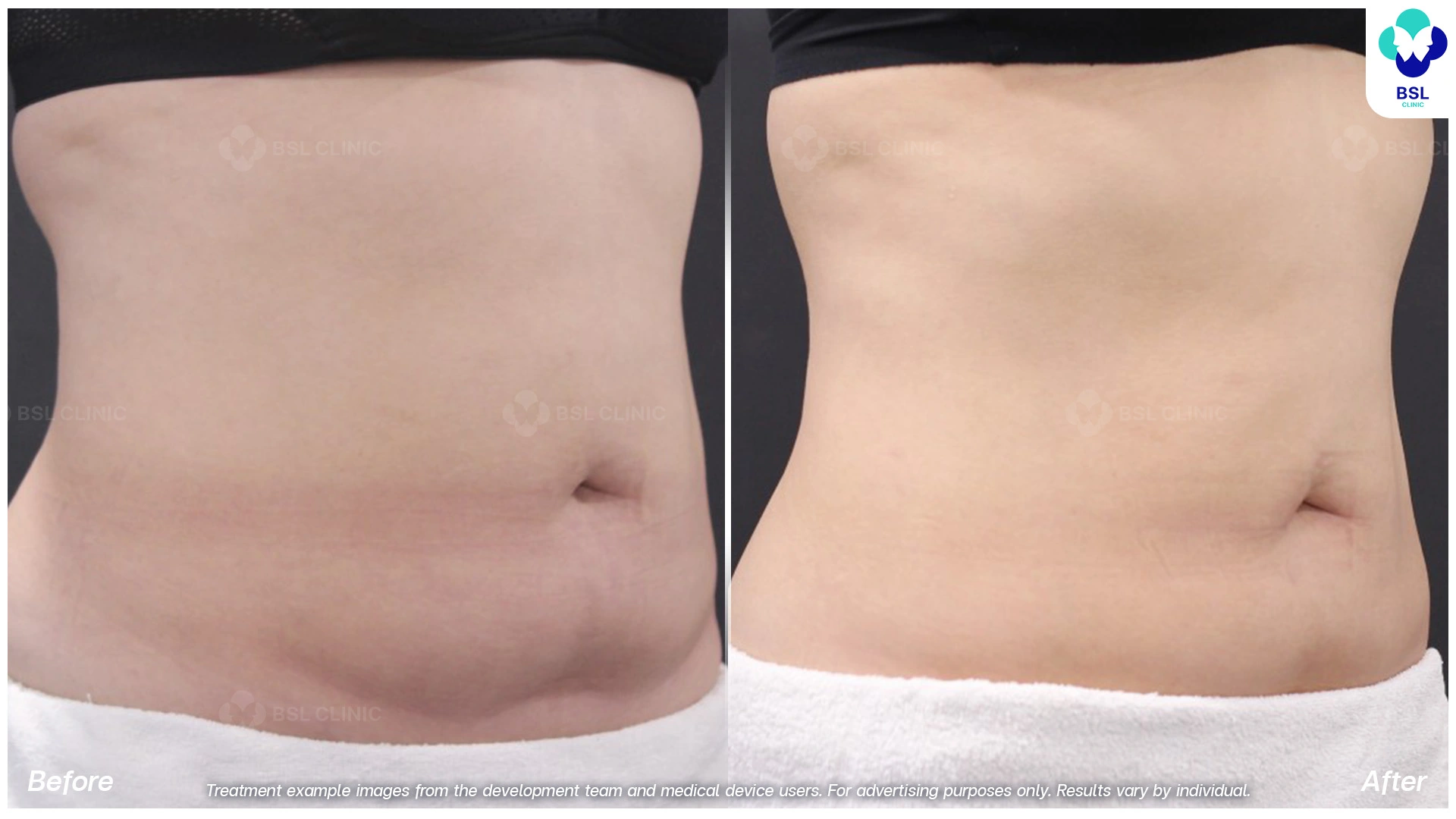 ผลลัพธ์จากการทำ CoolShaping2 Program