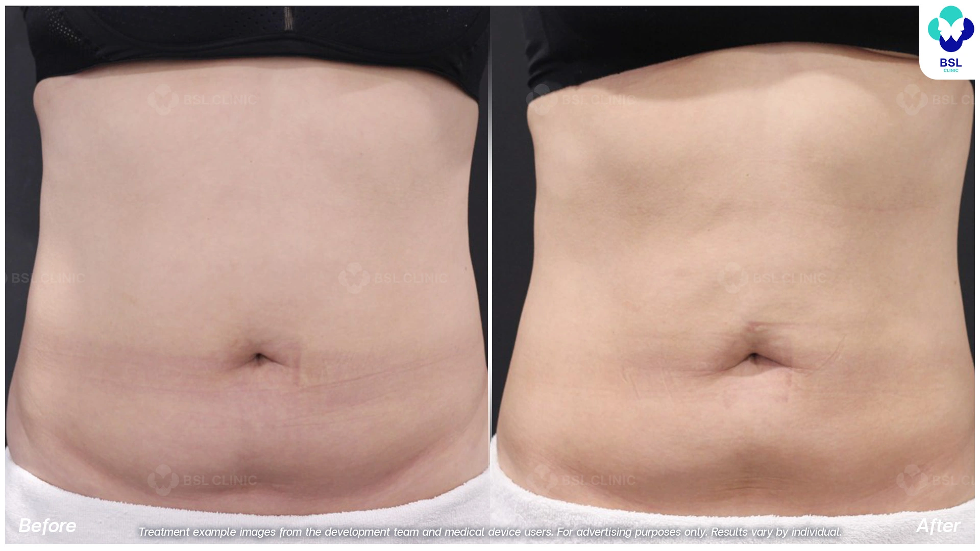 ผลลัพธ์จากการทำ CoolShaping2 Program