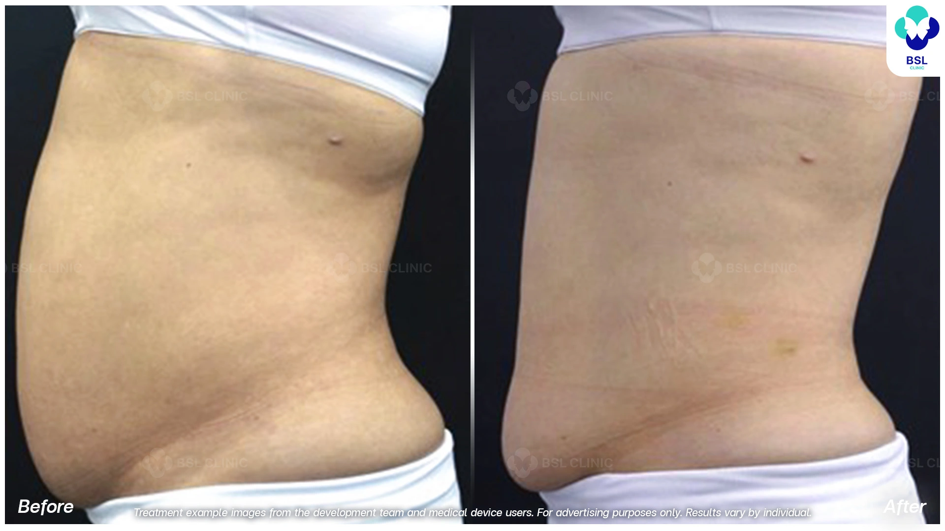ผลลัพธ์จากการทำ CoolShaping2 Program