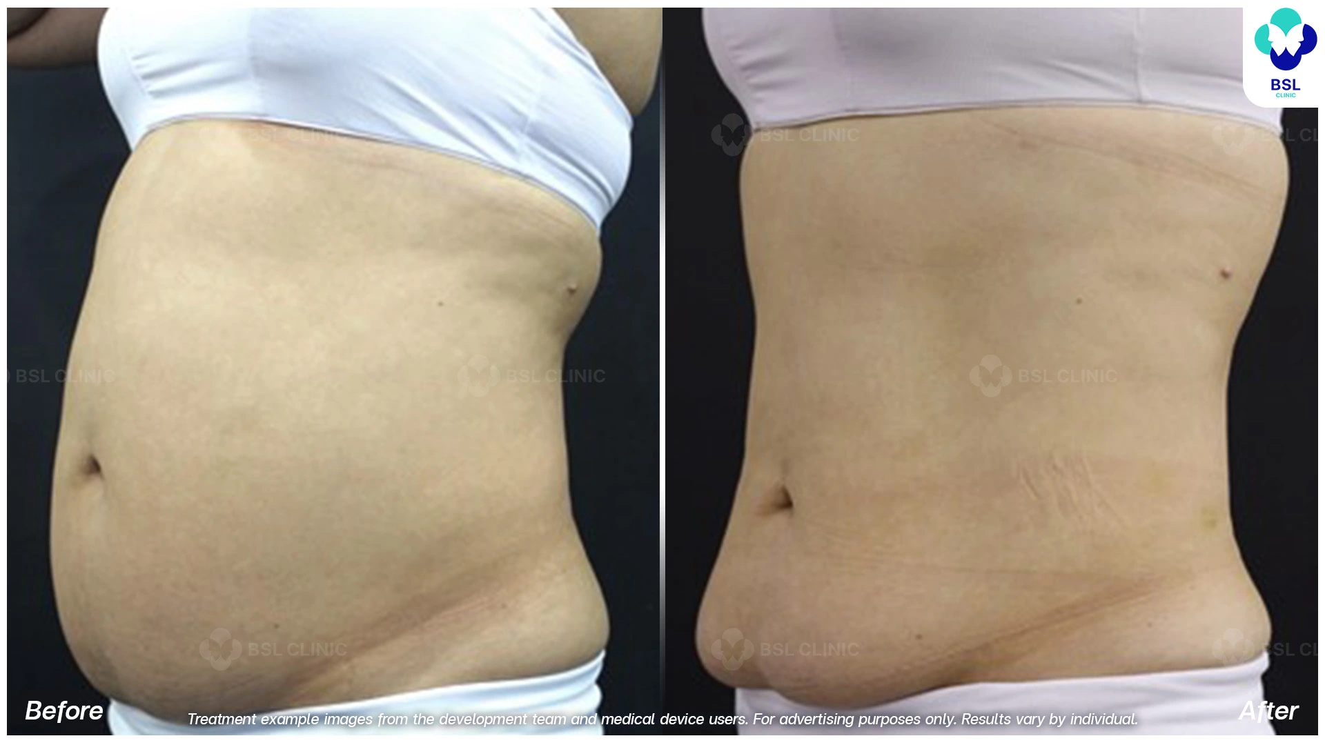 ผลลัพธ์จากการทำ CoolShaping2 Program