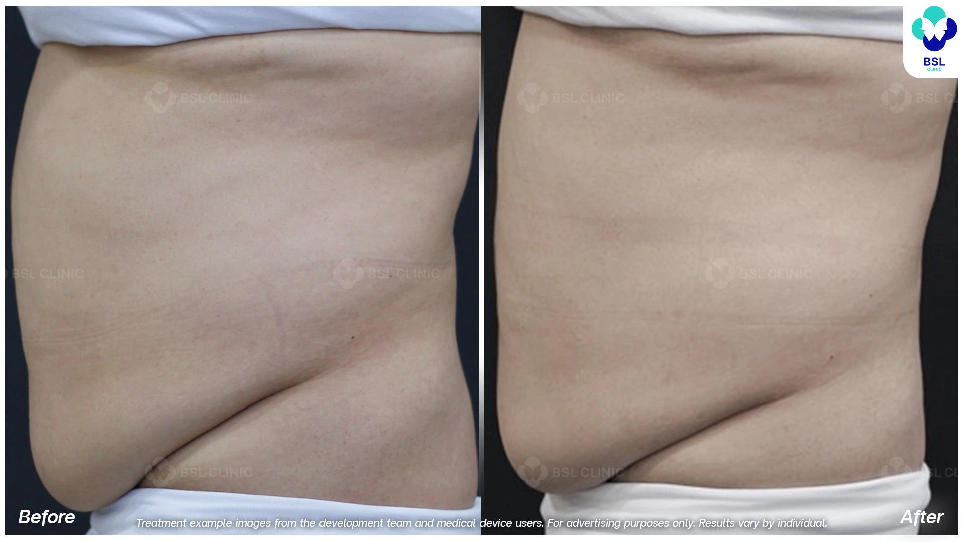 ผลลัพธ์จากการทำ CoolShaping2 Program