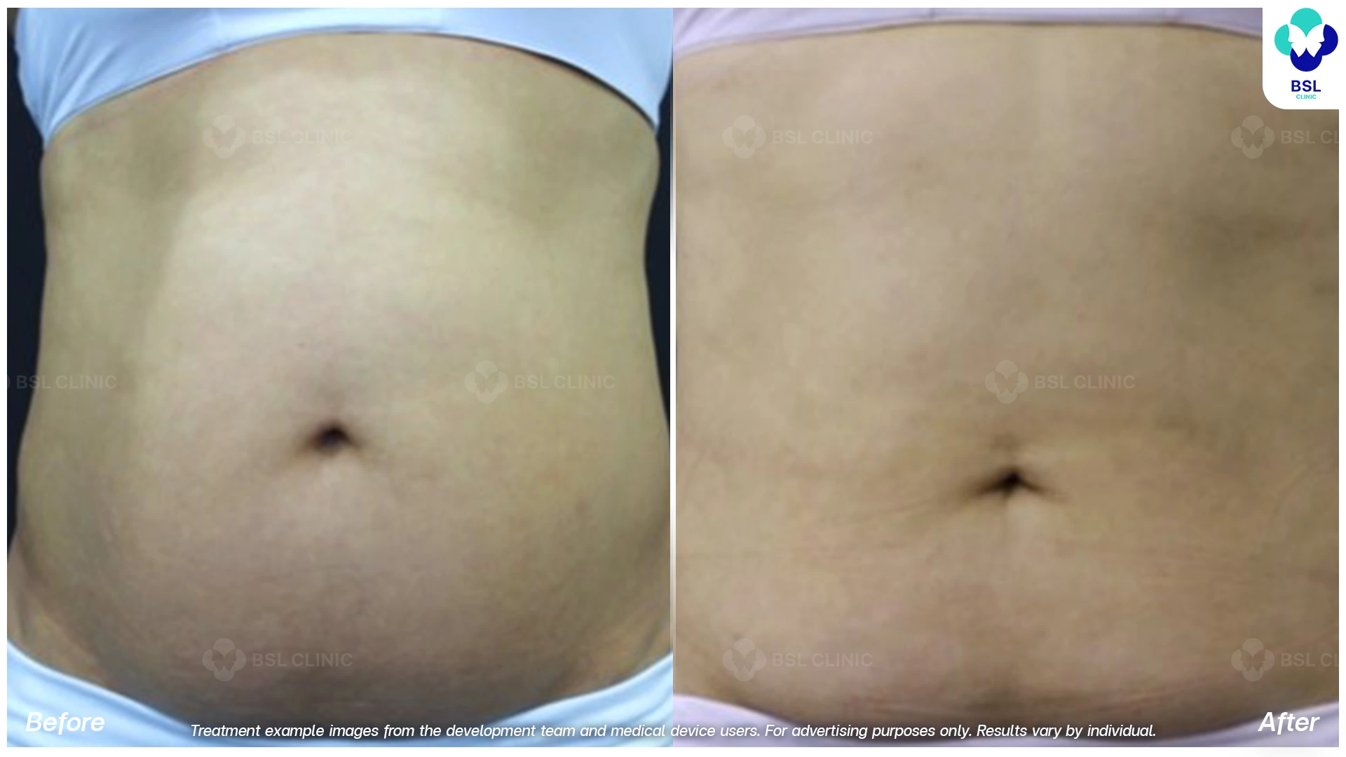 ผลลัพธ์จากการทำ CoolShaping2 Program