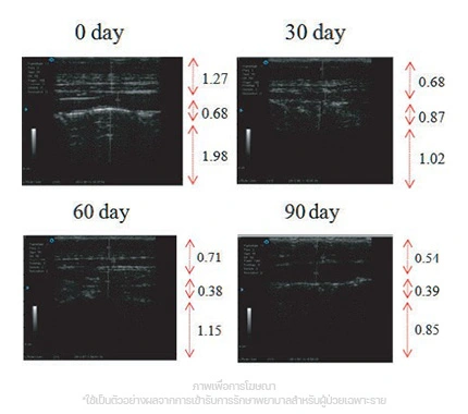 CoolShaping2-ผลลัพธ์จากงานวิจัย-ผลการอัลตราซาวด์