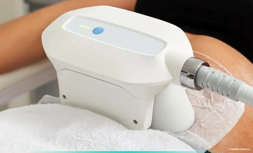 กลุ่มที่เหมาะกับ-CoolShaping-2-ไม่ต้องการผ่าตัด-ไม่ต้องพักฟื้น